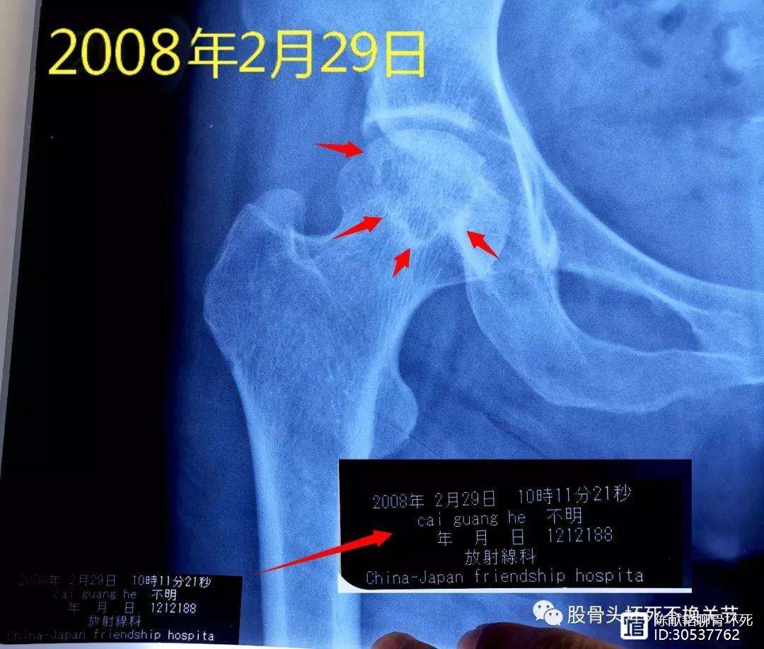 随州人工骨头医保报销多少(人工骨头医保报销多少比例)