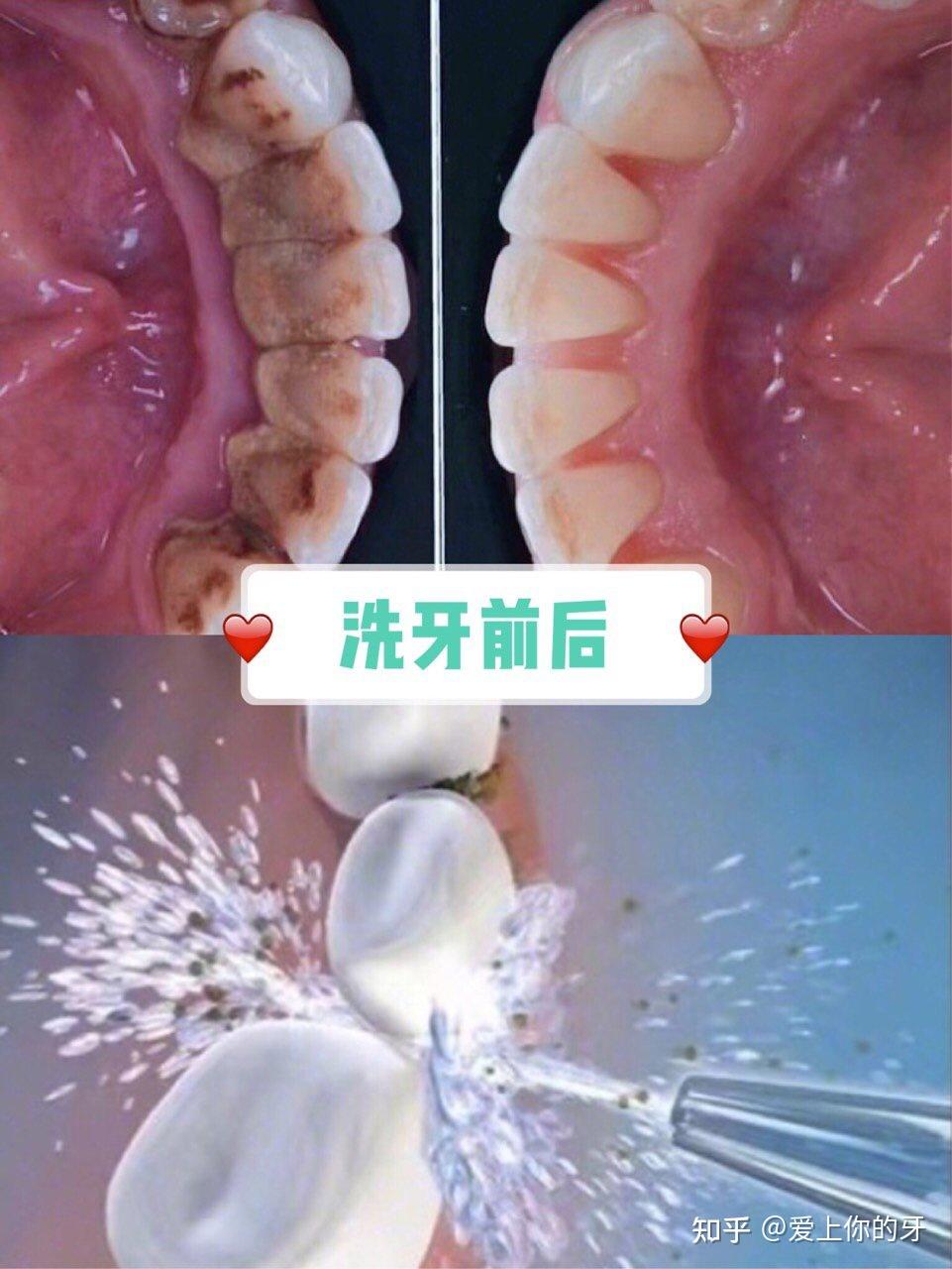 随州洗牙可以用医保吗(洗牙可以用医保吗,报销比例多少)